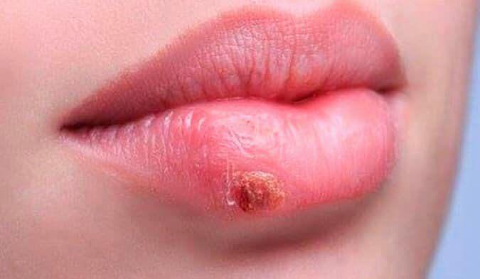 HERPE LABIAL